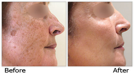 Constant Power Yag Laser Tattoo Removal Machine 2000MJ 1 - 10HZ Non Ablative Resurfacing