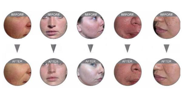5 Handles Facial Oxygen Jet Peel Beauty Equipment Facial Oxygen Therapy Machine