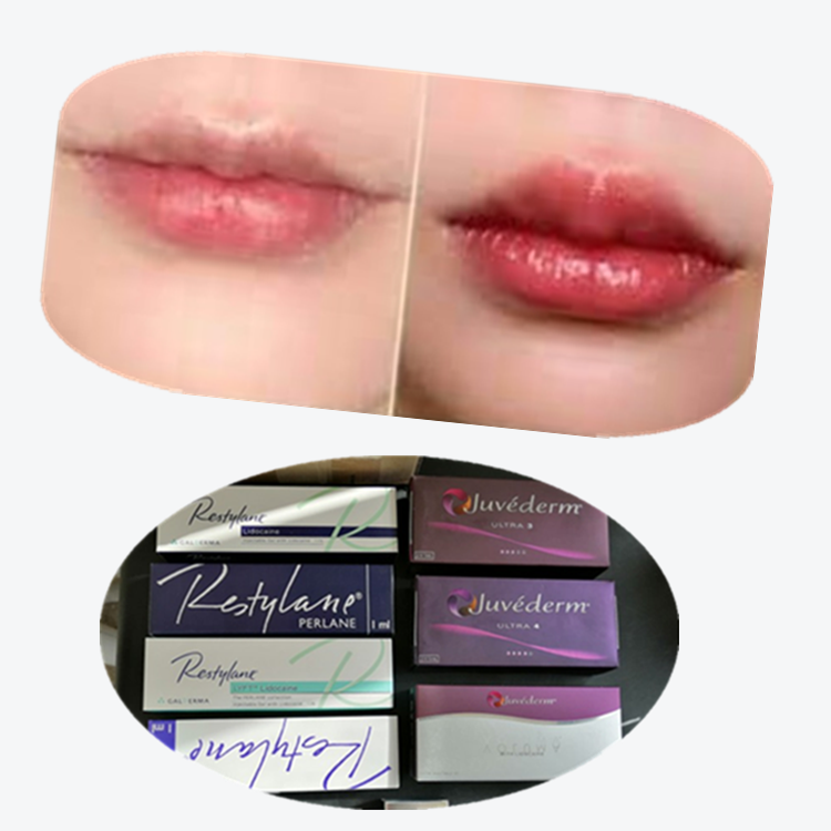 Dermal Filler Lip Injections Korean Original Authentic Products Lip Sodium Hyaluronate Filler