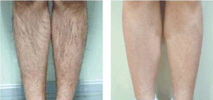 New design 4S multiple 2 display Beauty Machine-IPL&RF&E-light&Nd:YAG laser system