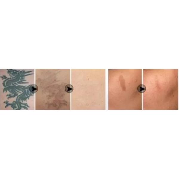 Q Switched ND Yag Laser Machine