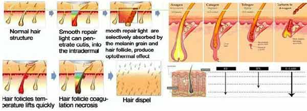 SHR hair removal and skin rejuventaion machine with 3000W input power in best price