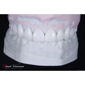 Durable Whitening porcelain veneer