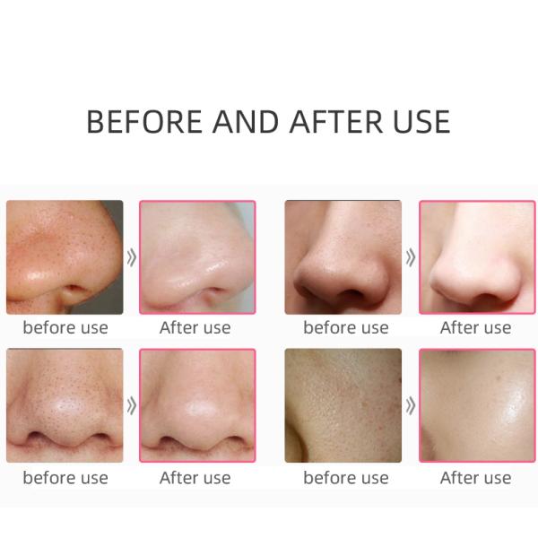 53kPa 3W Facial Vacuum Suction Machine Pore Cleanser Machine Replaceable Head