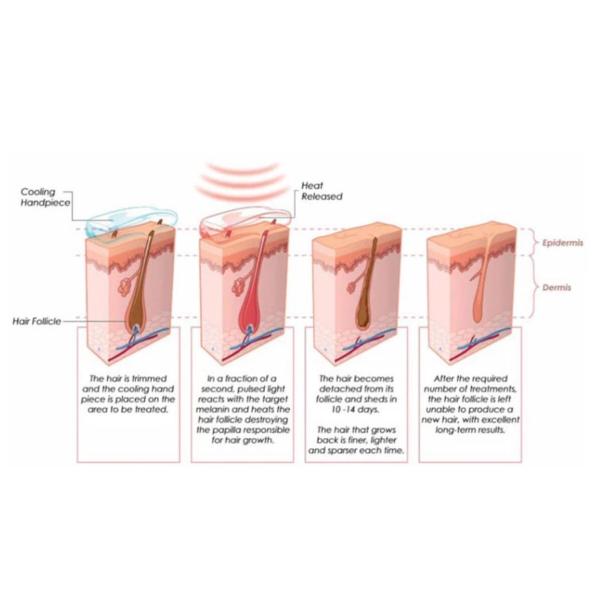 10 Bars 808nm Diode Laser Hair Removal Equipment