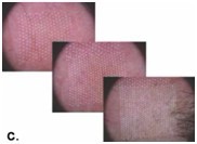 Pigmentation Removal CO2 Fractional Laser Machine For Skin Resurfacing 25W