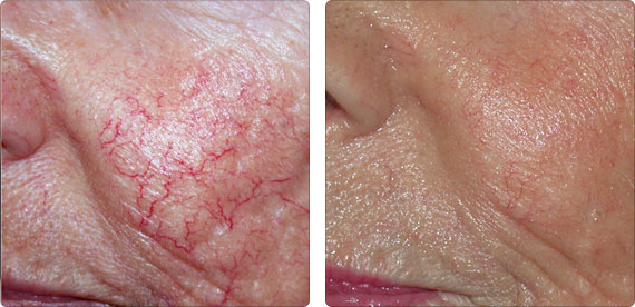 30MHZ with 150w power painless skin tags removal machine pupular in medical clinic