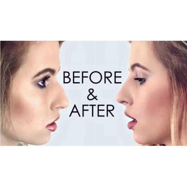 Juvederm Ultra 3 Hyaluronic Acid Dermal Filler , Hyaluronic Acid For Face Injections