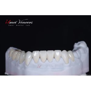 Strong and thin aesthetic veneers
