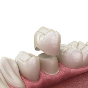 Quality OEM Natural Zirconia Dental Crown Unique Crack Resistant Tough Curing for sale