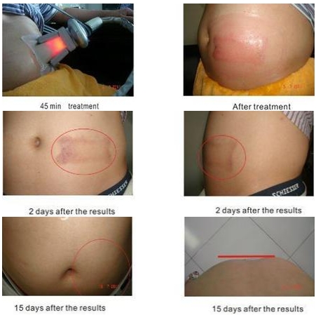 Multi-Functional beauty equipment kryolipolyse cool tech slimming machine cryolipolysis fat freezing equipment