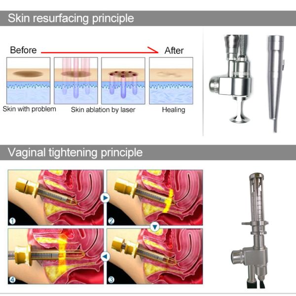 RF 10600nm 10.6um Fractional Co2 Laser female intimate areal Tightening Machine