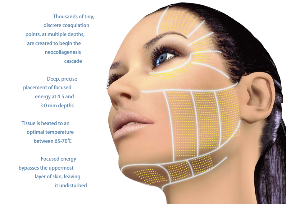 HIFU Face Lifting Machine NBW-HI