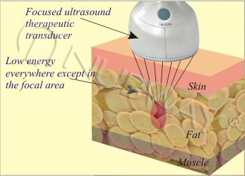 hifu slimming technology.jpg