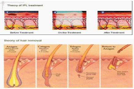Vertical IPL Hair Removal Machine For Skin Rejuvenation Wrinkle Removal