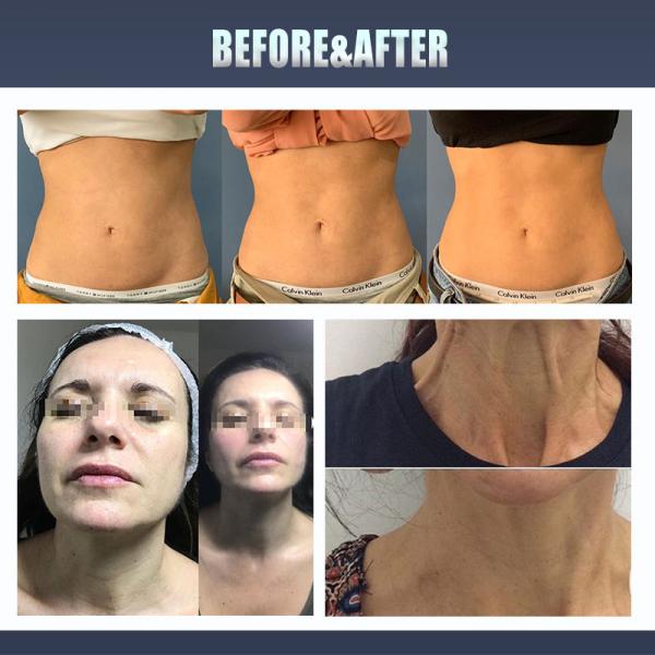 Multifunction Portable Hifu Face Lifting 3D 4D 5D Skin Tightening HIFU Machine