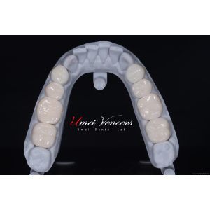 Durable Whitening porcelain veneer