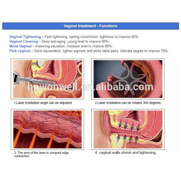 Factory directly fractional co2 laser wart removal machine with ance treatment