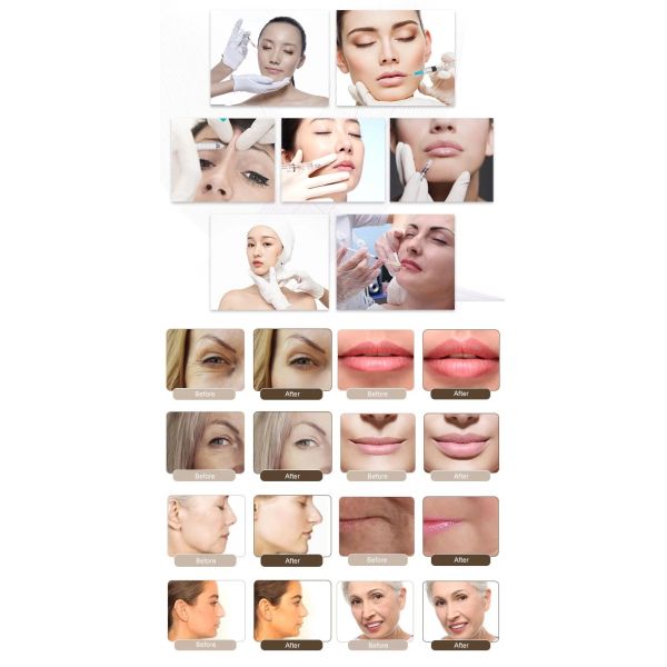 Revolax Hyaluronic Acid Facial Fillers For Facial Enlargement