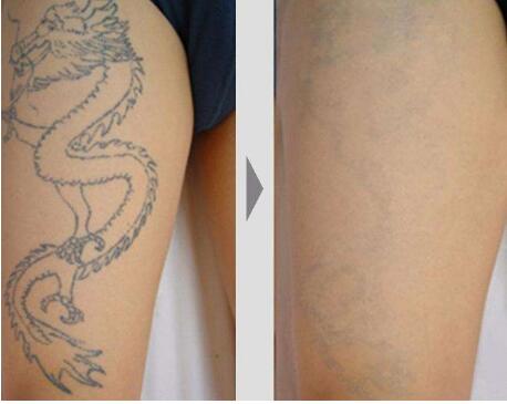 Multifunctional IPL Laser Hair Removal Machine Vertical Style For Skin Whitening