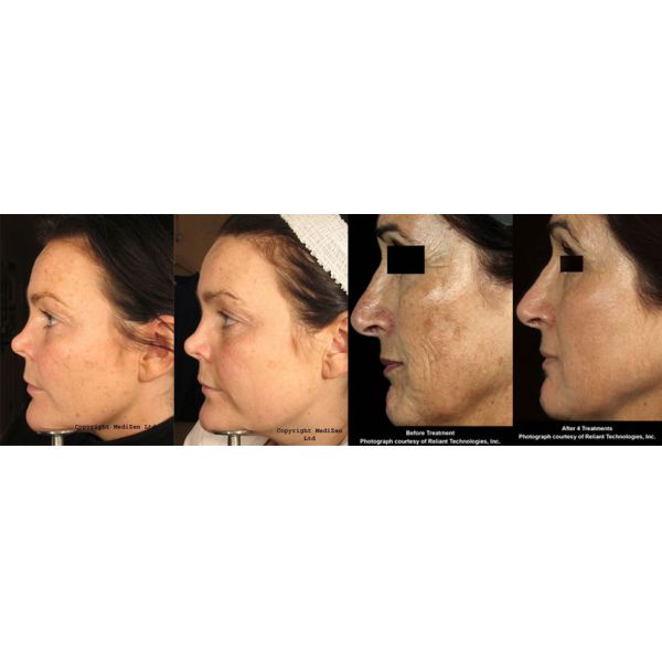 3 In 1 CO2 Fractional Laser Machine , 8.4'' Vaginal Tightening Treatment