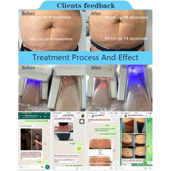 Best result cryolipolysis 4 handles fda cryotherapy slimming beauty instrument for spa