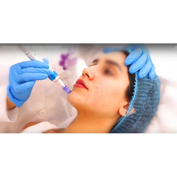 Personal Care Hyaluronic Acid Wrinkle Fillers Lines Around Mouth Fillers