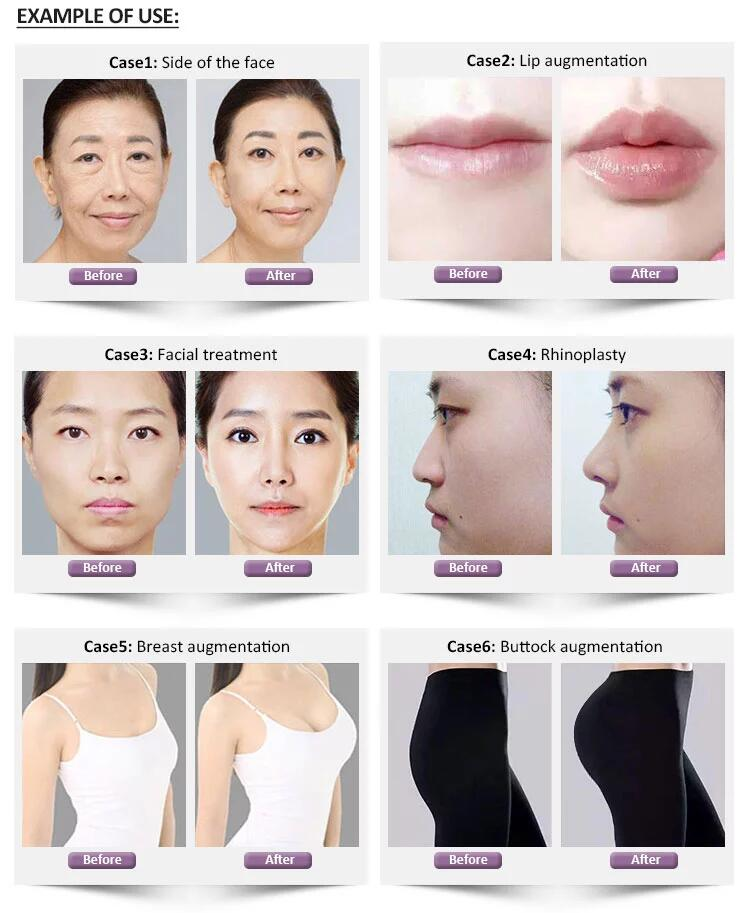 Ha Fillmed Filorga 135ha Injection Mesotherapy For Face Pigmentation